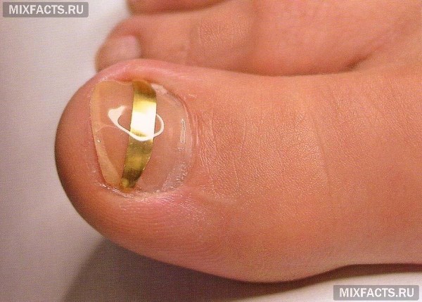 Що робити, якщо вростає ніготь?