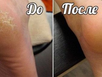 Апаратний педикюр (24 фото): як робити обробку нігтів покроково? Плюси і мінуси професійної медичної техніки, відгуки