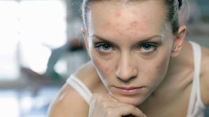 Безбарвна хна для обличчя: як використовувати білу хну для шкіри обличчя і який від неї ефект? Допомагає від прищів і від зморшок?