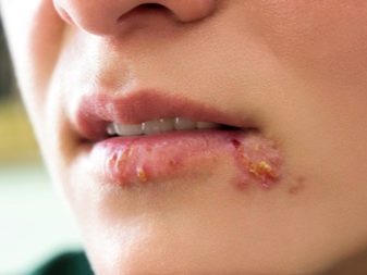 Феруловый пілінг (31 фото): що це таке, процедура з ферулової кислоти для обличчя, догляд після проведення відгуки косметологів