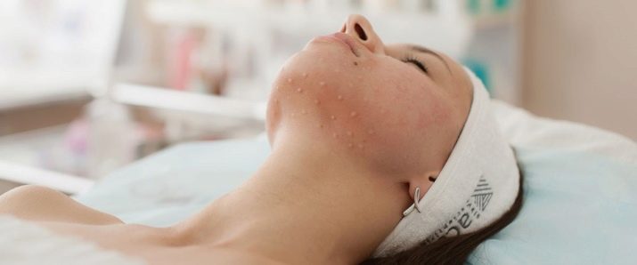 Juvederm Hydrate для біоревіталізації (19 фото): склад, ефект від курсу і відгуки косметологів
