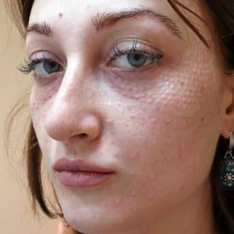 Juvederm Hydrate для біоревіталізації (19 фото): склад, ефект від курсу і відгуки косметологів