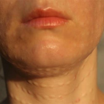 Juvederm Hydrate для біоревіталізації (19 фото): склад, ефект від курсу і відгуки косметологів