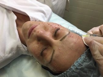 Juvederm Hydrate для біоревіталізації (19 фото): склад, ефект від курсу і відгуки косметологів