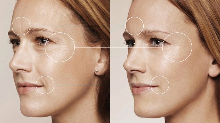 Juvederm Hydrate для біоревіталізації (19 фото): склад, ефект від курсу і відгуки косметологів