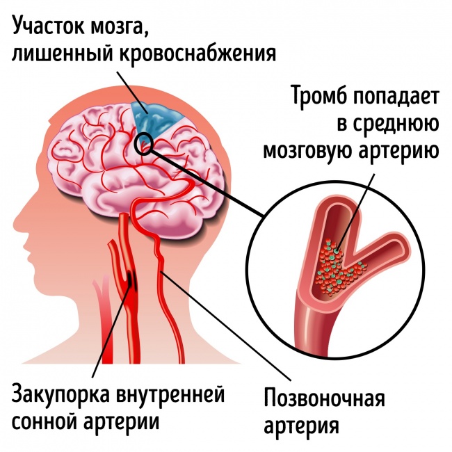 Що потрібно знати про «тихому інсульті» — третій у світі причини раптової смерті