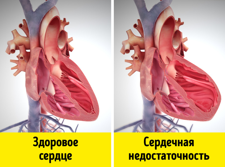 Що таке серцева недостатність і чому варто дізнатися про неї зараз і розповісти близьким