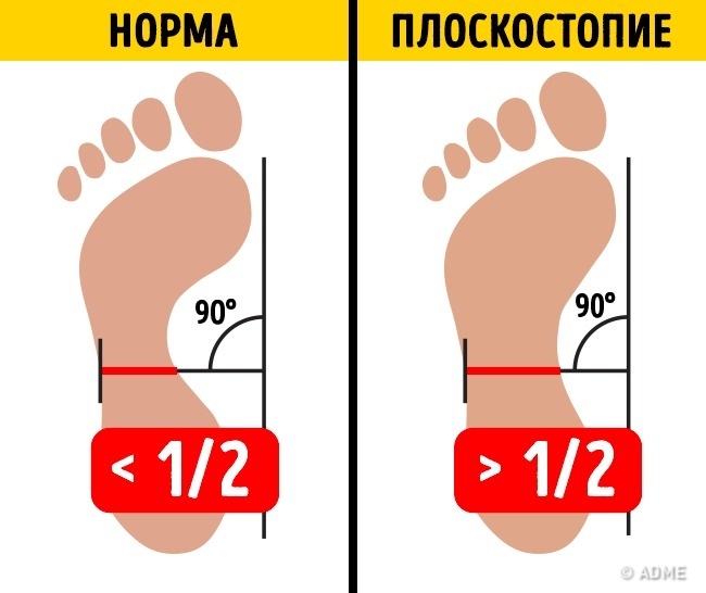 Всього 2 вправи, і плоскостопість вас не потурбує